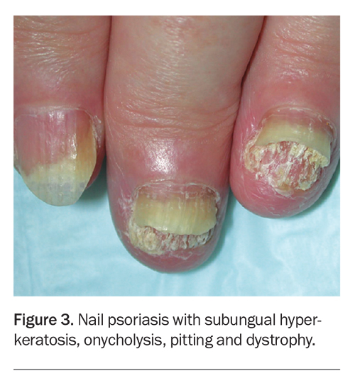 Evaluation And Management Of Nail Diseases Medicine Today 2222